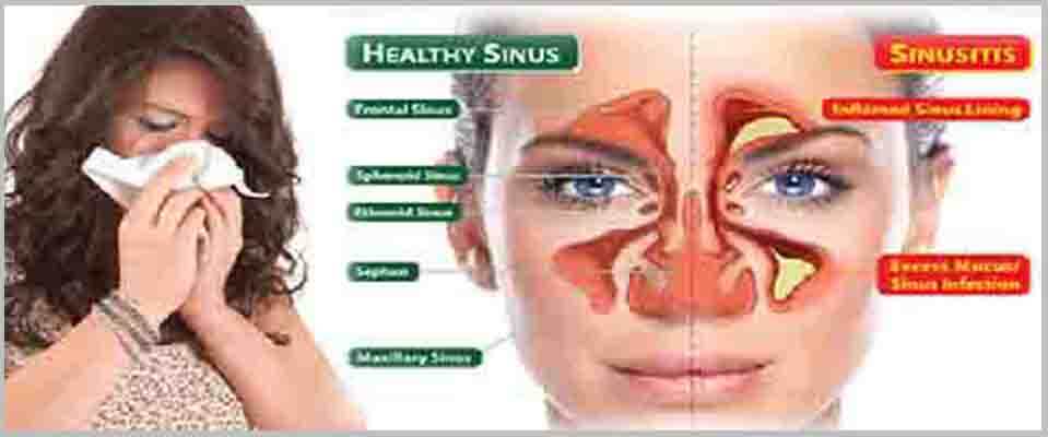 Ayurvedic Treatment of Sinusitis
